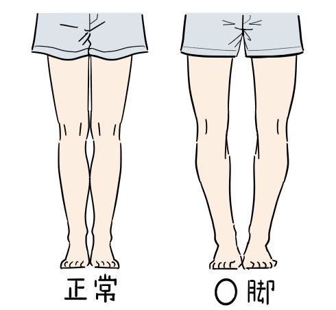 正常な状態とO脚の画像